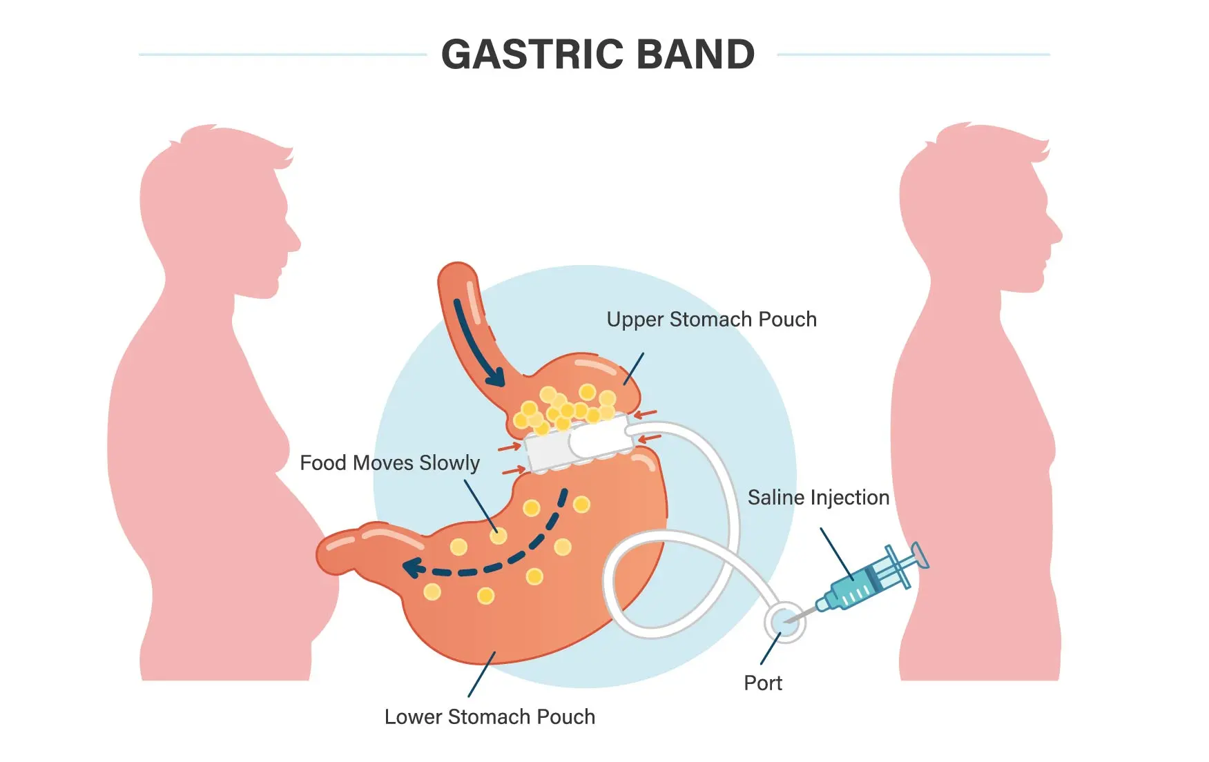 gastric-band